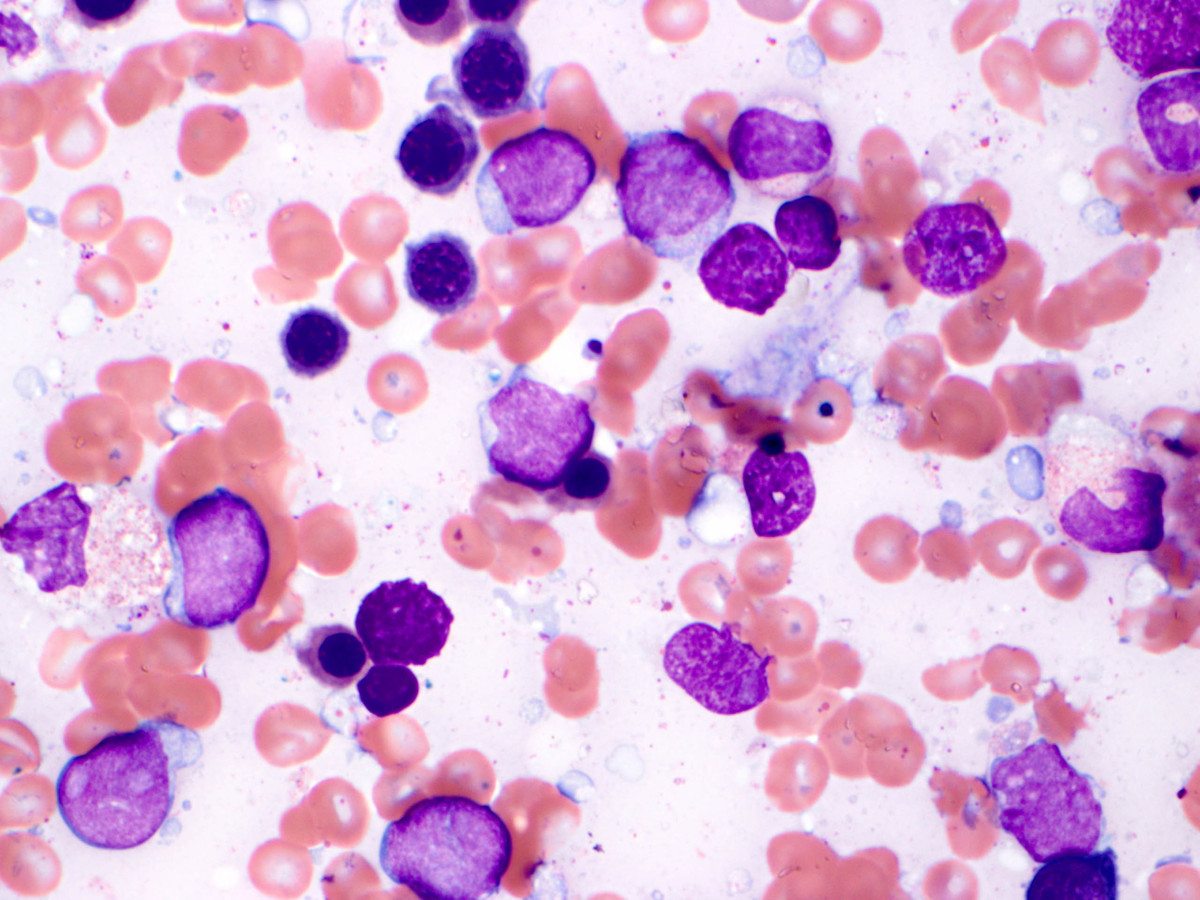 High power view of aspirate smear showing numerous blast forms.